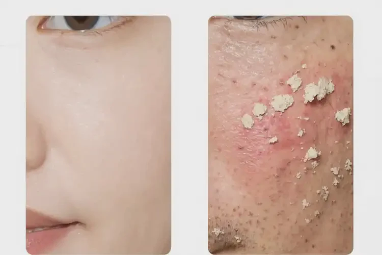 男性屁股起濕疹不管它會自己好嗎(圖1)