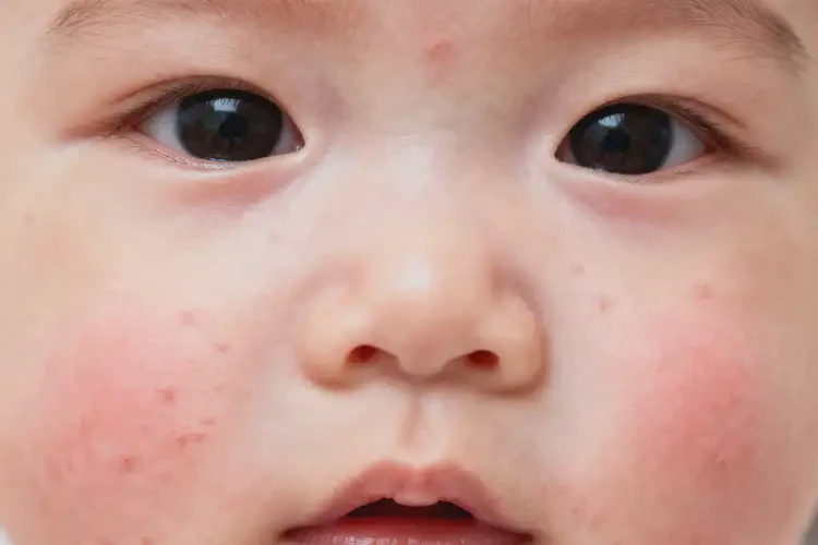 嬰幼兒面部長(zhǎng)濕疹能徹底自愈嗎(圖1)