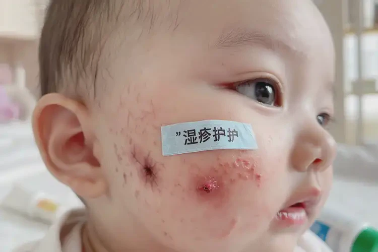 小孩臉上出濕疹可以徹底自愈嗎(圖4)