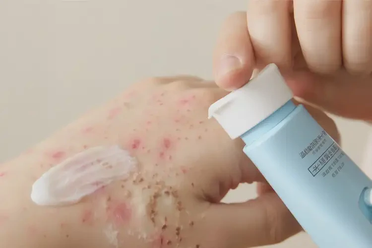 孩子手上經(jīng)常長(zhǎng)濕疹不管它會(huì)自己痊愈嗎(圖3)