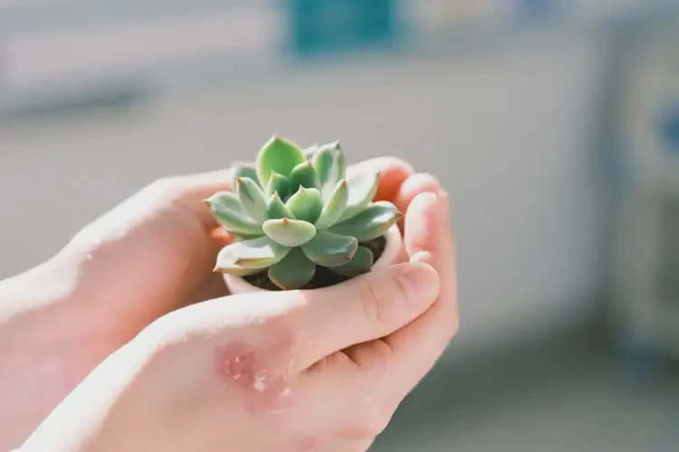 大學(xué)生手上出濕疹能徹底自愈嗎(圖2)