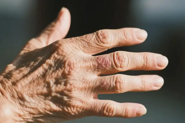 老年人手上有濕疹不管它會(huì)自己痊愈嗎(圖1)