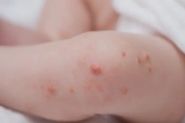 新生兒小腿上經(jīng)常起濕疹不管它會(huì)自己自愈嗎(圖4)