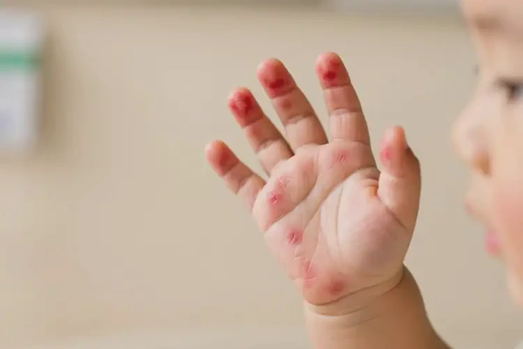 幼兒手上長(zhǎng)濕疹不管它會(huì)自己痊愈嗎(圖4)