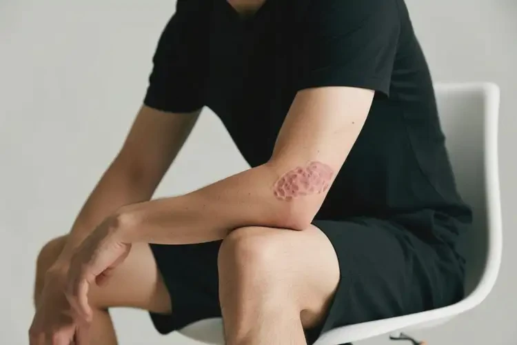 男性身上經(jīng)常長濕疹不管它會自己痊愈嗎(圖3)