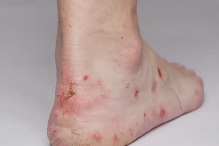 中學(xué)生腳上有濕疹能靠自己自愈嗎(圖4)