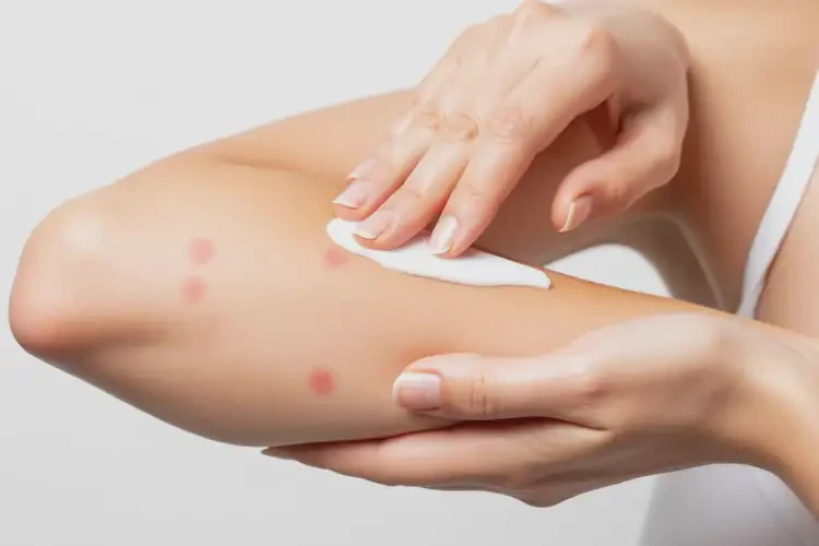 青年人身上偶爾起濕疹可不可以徹底自愈(圖4)