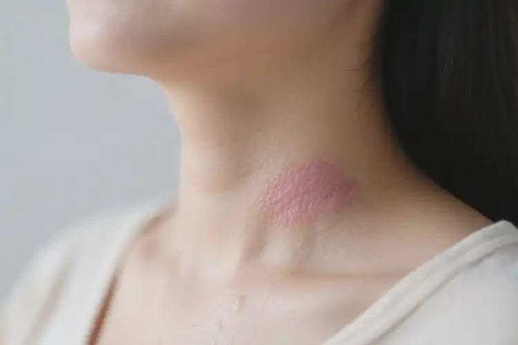 產(chǎn)婦脖子偶爾起濕疹可不可以徹底自愈(圖3)