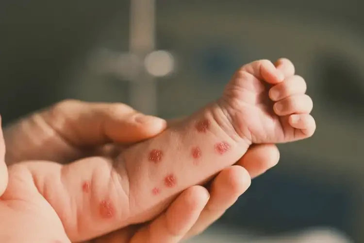 新生兒手臂經(jīng)常長濕疹不管它會自己痊愈嗎(圖4)