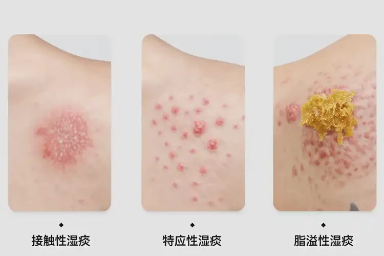 男生肚子上容易起濕疹不管它會(huì)自己好嗎(圖2)