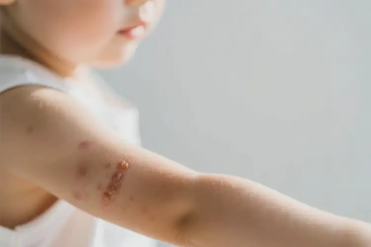 孩子身上偶爾長濕疹不管它會自己痊愈嗎(圖4)