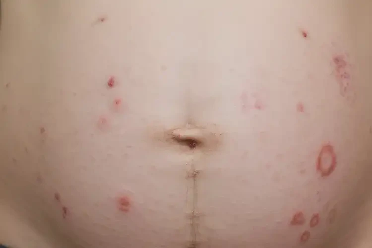 孕婦肚子出現(xiàn)濕疹不管它會(huì)自己自愈嗎(圖4)