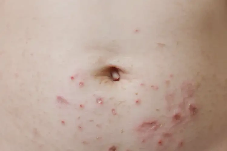 嬰幼兒肚子上經(jīng)常起濕疹可以徹底自愈嗎(圖4)