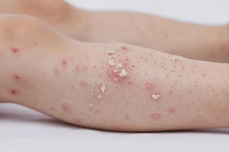 少兒小腿起濕疹能靠自己自愈嗎(圖3)