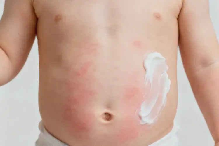 孩子肚子上偶爾起濕疹能徹底自愈嗎(圖4)