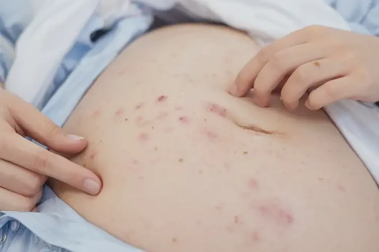 產(chǎn)婦肚子上有濕疹可不可以徹底自愈(圖4)