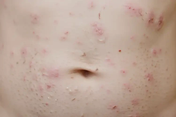 兒童肚子上容易起濕疹能徹底自愈嗎(圖4)