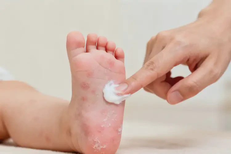 新生兒腳上容易長濕疹能夠徹底治愈嗎(圖4)