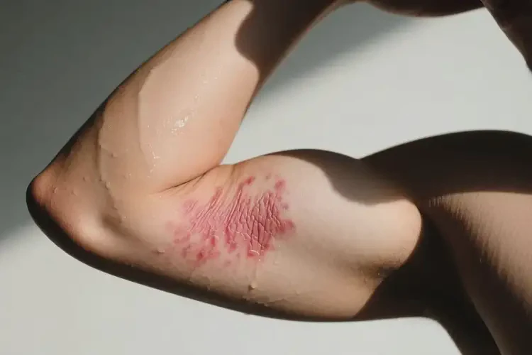 男人手臂上起濕疹不管它會自己好嗎(圖1)