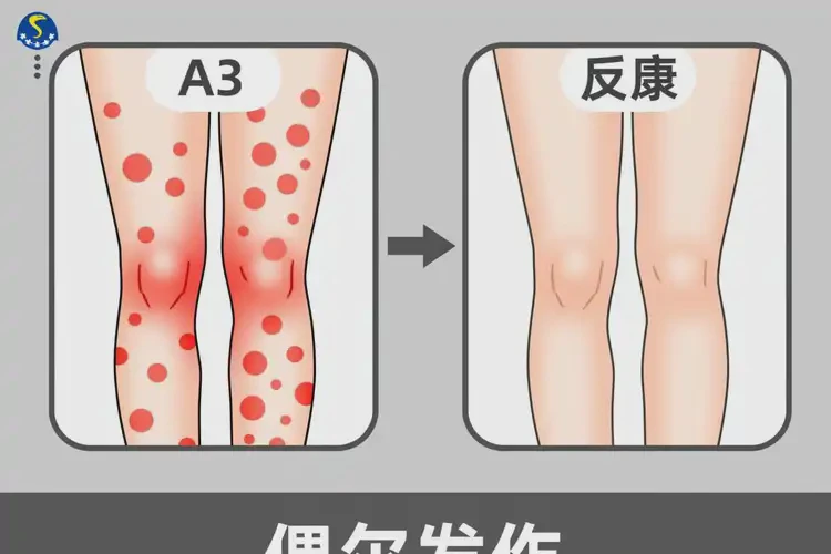 女生小腿偶爾長(zhǎng)濕疹可不可以徹底自愈(圖3)