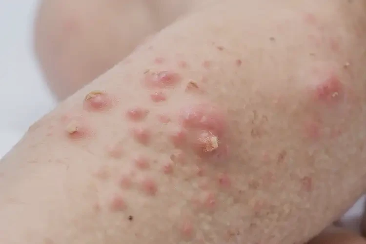 兒童小腿上經(jīng)常起濕疹可不可以徹底自愈(圖4)