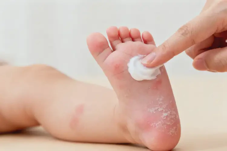 新生兒腳上容易長濕疹能夠徹底治愈嗎(圖2)