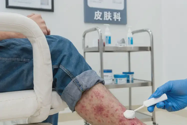 青年人小腿上容易長(zhǎng)濕疹不管它會(huì)自己好嗎(圖3)