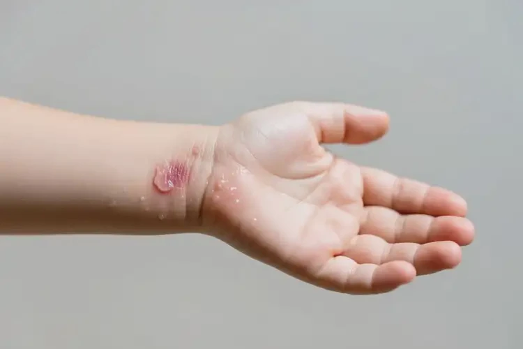 小孩手臂偶爾起濕疹不管它會自己好嗎(圖2)