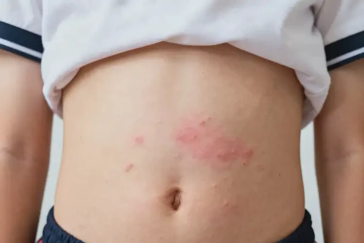 中學(xué)生肚子上出現(xiàn)濕疹可以徹底自愈嗎(圖4)