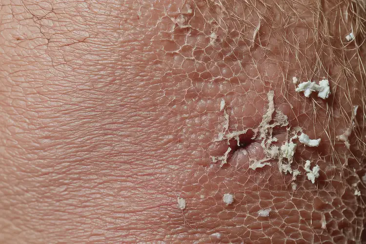 男性小腿經(jīng)常起濕疹可以徹底自愈嗎(圖3)