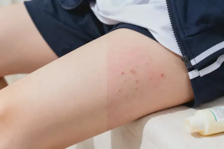 大學(xué)生小腿上容易起濕疹可不可以徹底自愈(圖2)