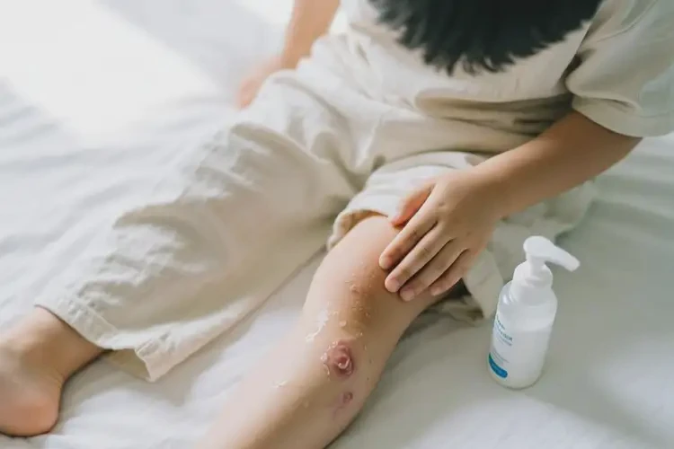 孩子大腿經(jīng)常起濕疹能夠徹底治愈嗎(圖3)