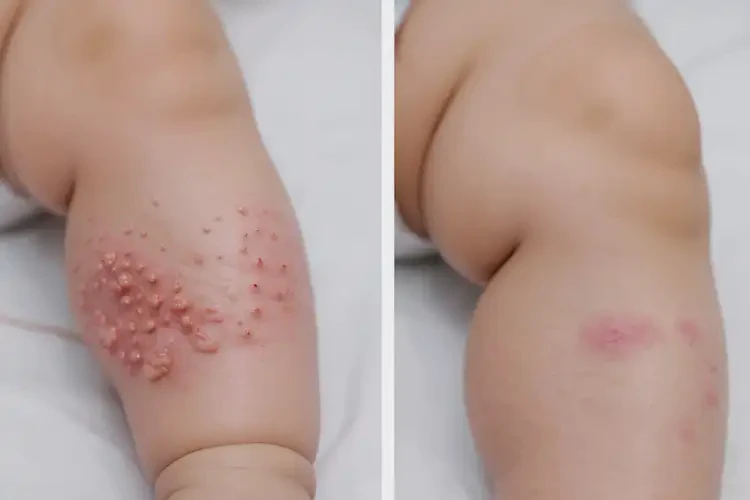 嬰兒大腿上長濕疹不管它會自己痊愈嗎(圖1)