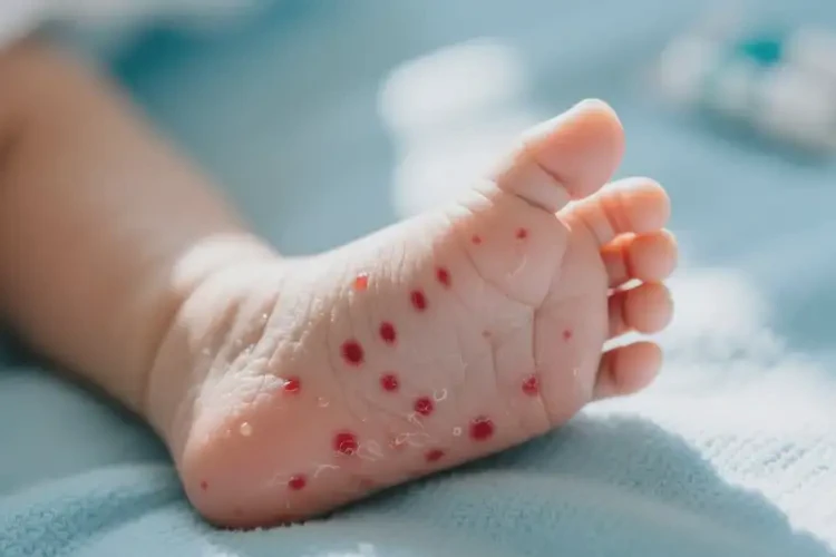 新生兒腳上出濕疹不管它會(huì)自己自愈嗎(圖1)