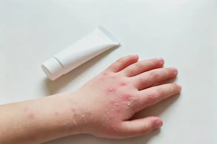 小孩手上长湿疹能靠自己自愈吗(图3)