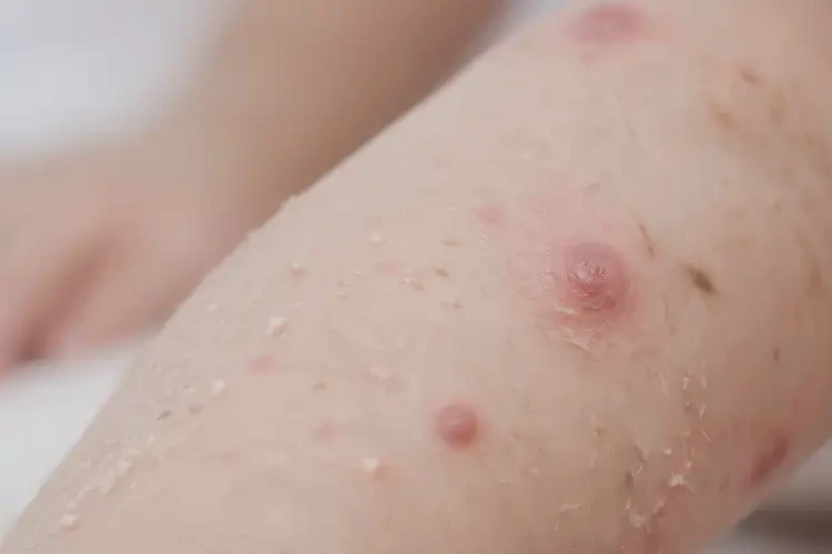 幼儿屁股上有湿疹能够彻底治愈吗(图4)