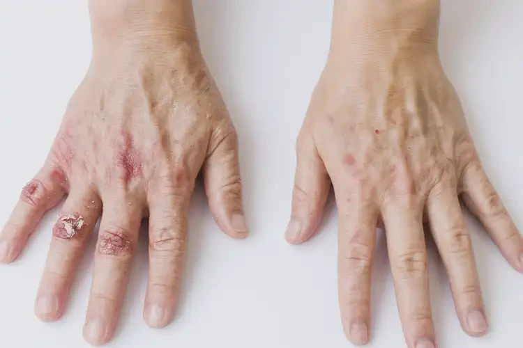 女性手上起濕疹不管它會自己好嗎(圖1)