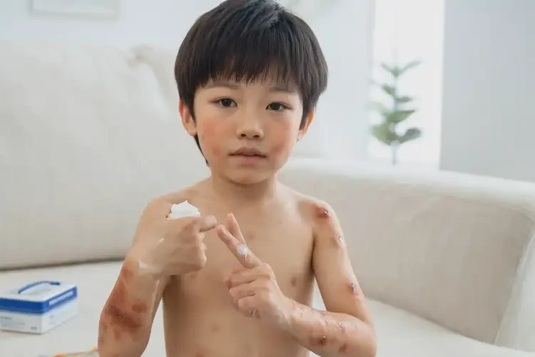 小兒手上長(zhǎng)濕疹能徹底自愈嗎(圖2)