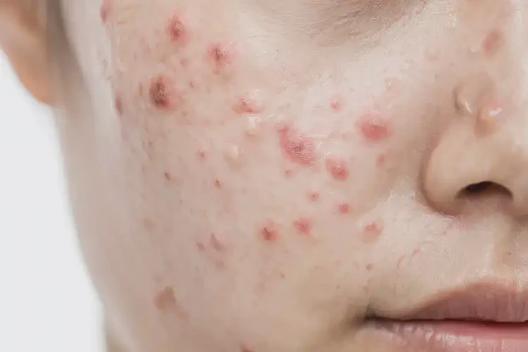 女生屁股上起濕疹可以徹底自愈嗎(圖3)