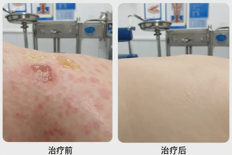 女人四肢长湿疹可不可以彻底自愈(图1)