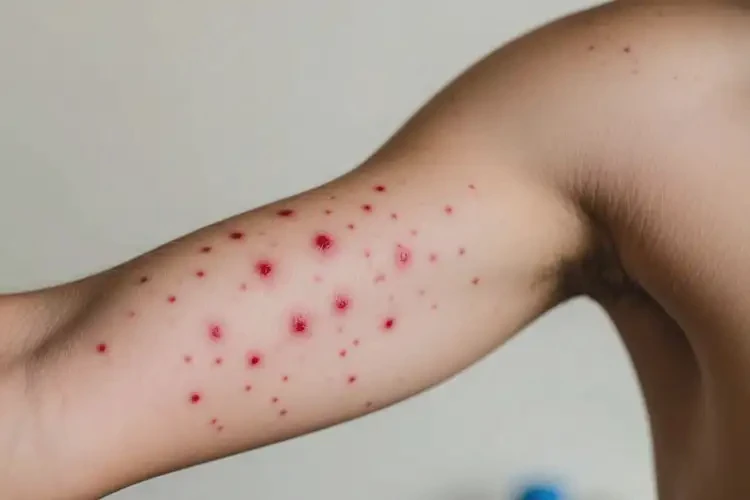 中學(xué)生手臂上偶爾起濕疹不管它會(huì)自己自愈嗎(圖1)