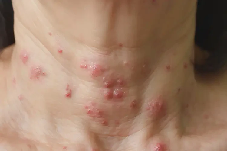 女性脖子上出湿疹不管它会自己痊愈吗(图4)