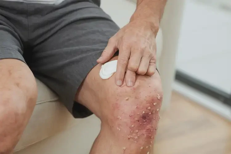 男性小腿經(jīng)常起濕疹可以徹底自愈嗎(圖2)