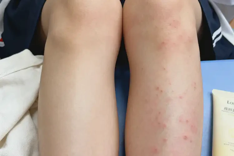 大學(xué)生小腿上容易起濕疹可不可以徹底自愈(圖1)