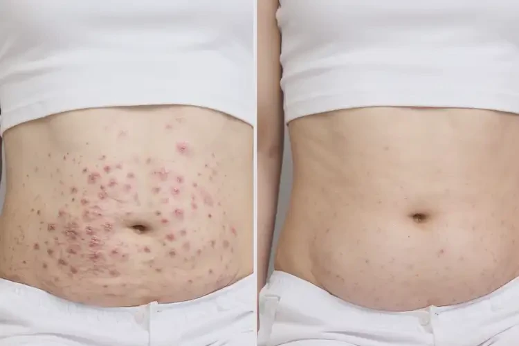女生肚子經(jīng)常長(zhǎng)濕疹不管它會(huì)自己痊愈嗎(圖1)
