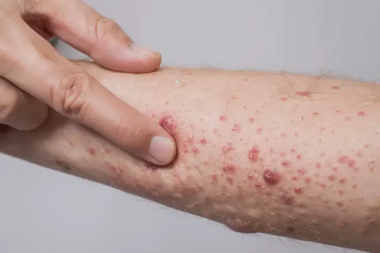 男人身上經(jīng)常起濕疹能徹底自愈嗎(圖4)