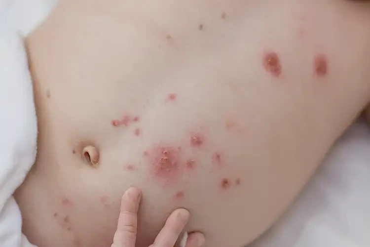 新生兒肚子上有濕疹能靠自己自愈嗎(圖4)