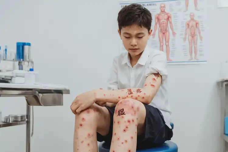 青少年四肢容易起濕疹不管它會自己自愈嗎(圖4)