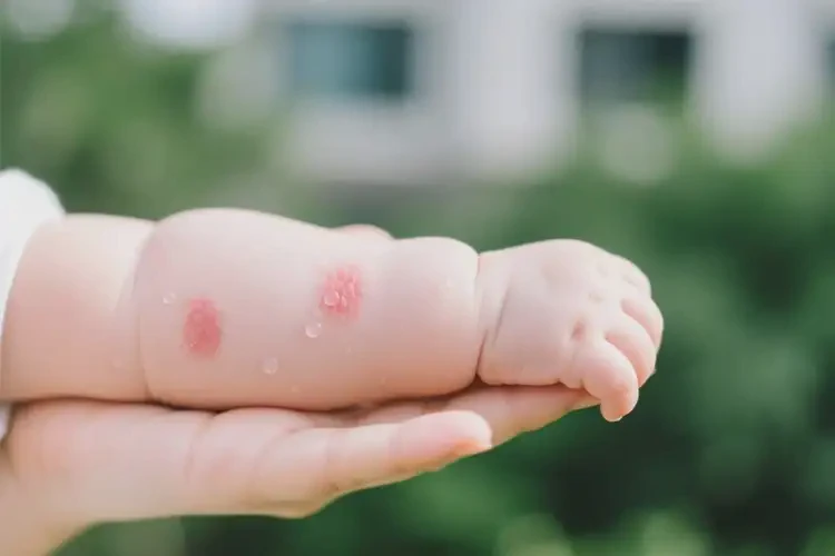 嬰幼兒手臂上偶爾長(zhǎng)濕疹能靠自己自愈嗎(圖1)