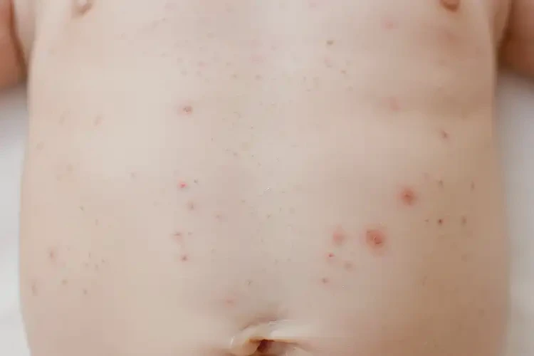 小孩肚子上出现湿疹可以彻底自愈吗(图3)